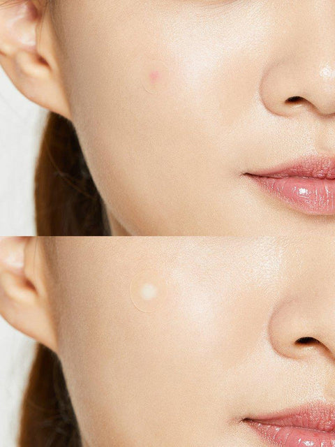 Acne Pimple Patch